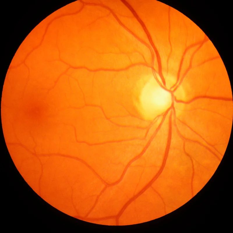 Retinal fundus photograph showing the optic disc and blood vessels of the eye