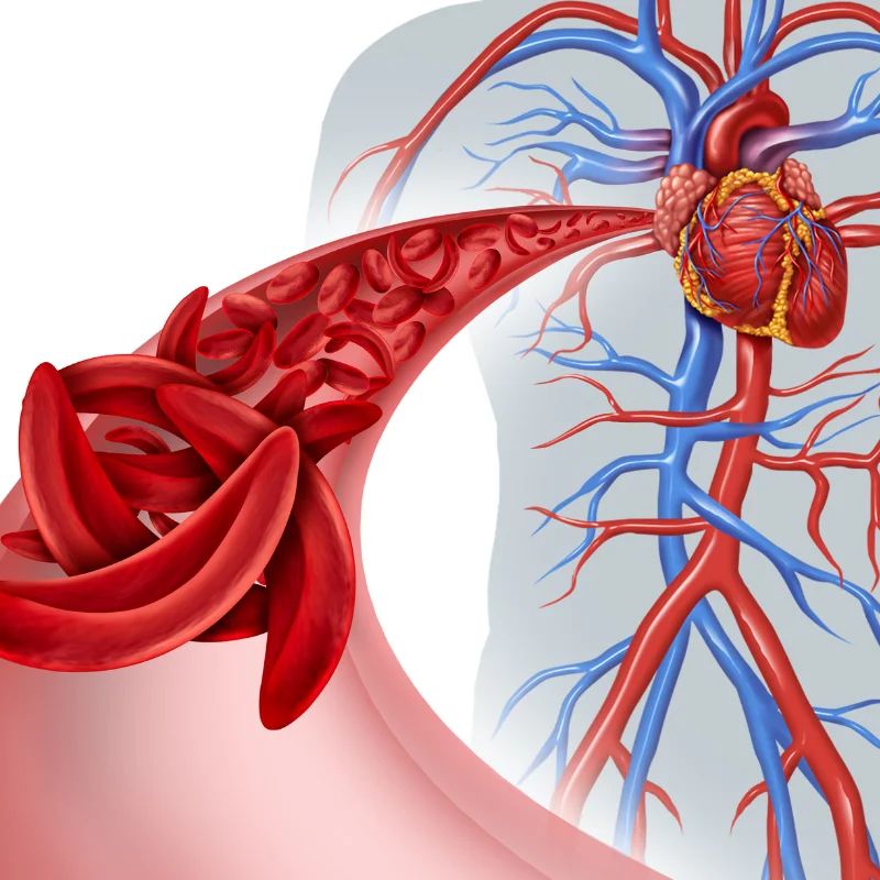 Medical illustration of sickle-shaped red blood cells in a vessel beside the heart and circulatory system