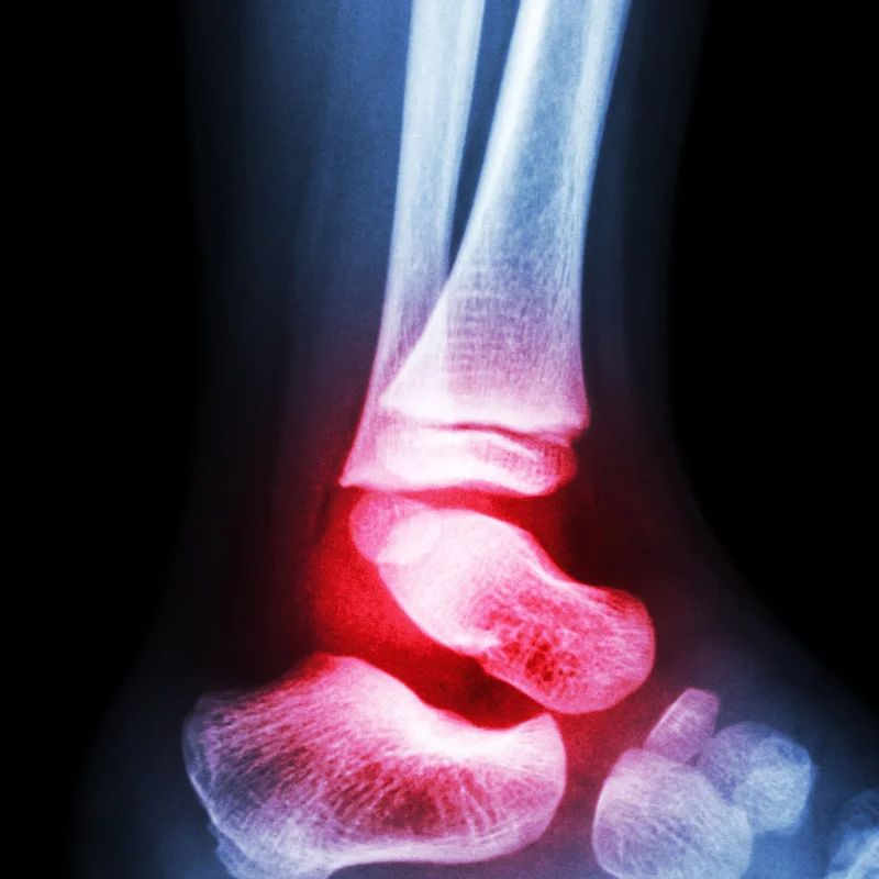 X-ray of an ankle joint with inflammation highlighted in red