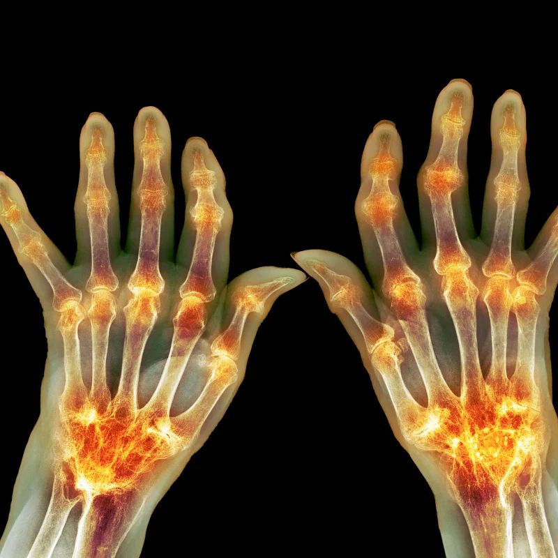 Colorized X-ray of two hands with inflamed joints glowing orange from rheumatoid arthritis